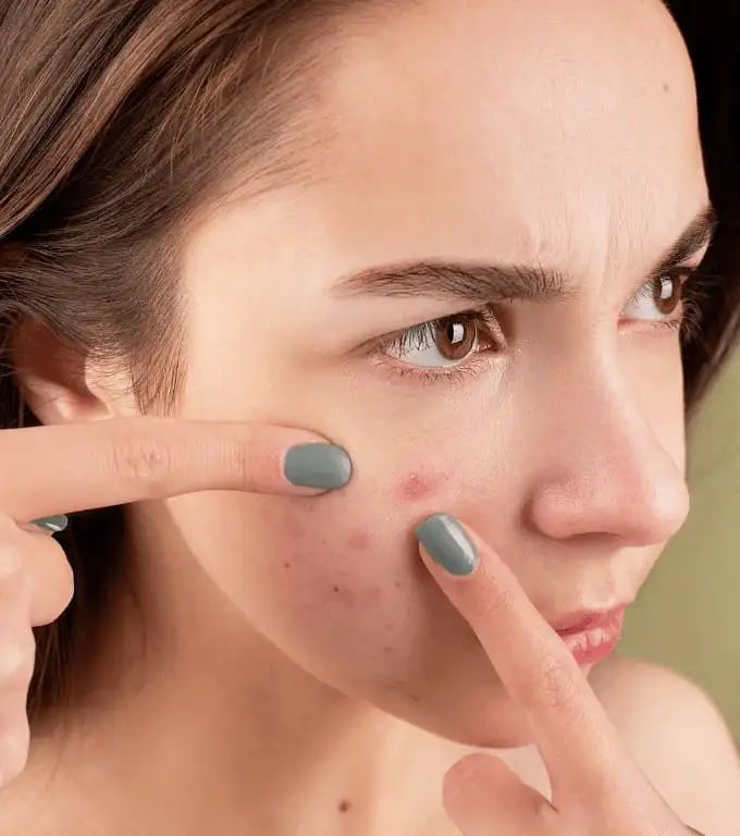 Acne & Skincare